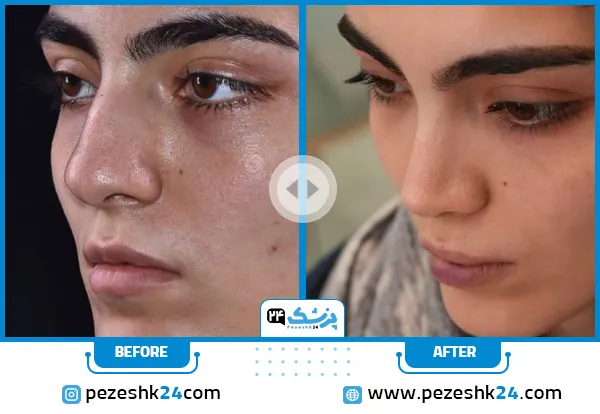 نمونه کار قبل و بعد عمل بینی دکتر سارا ارژنگ در تهران