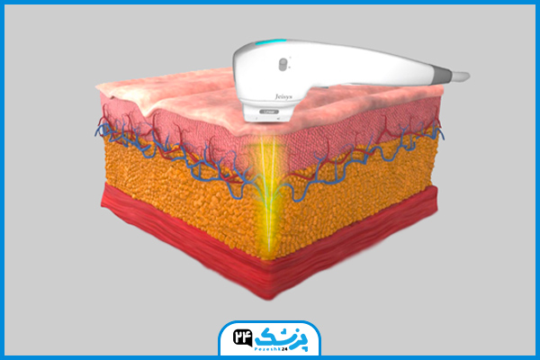 عکس هایفوتراپی چگونه انجام می شود