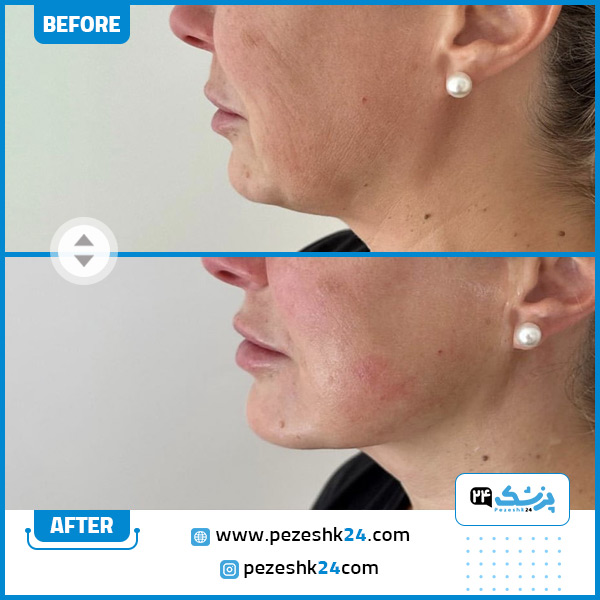 عکس قبل و بعد هایفوتراپی صورت