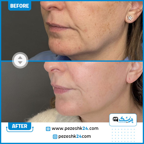 عکس قبل و بعد هایفو صورت