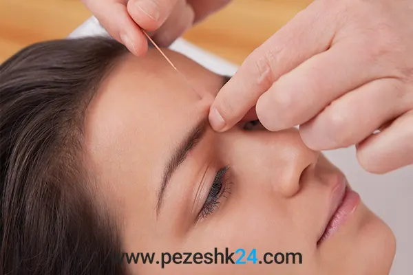 لیفت بینی با نخ