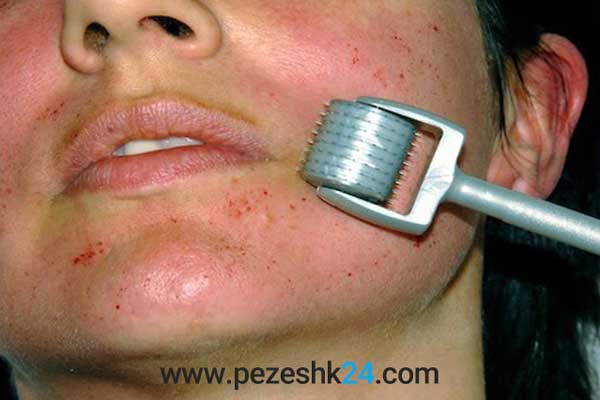 میکرو نیدلینگ دستی