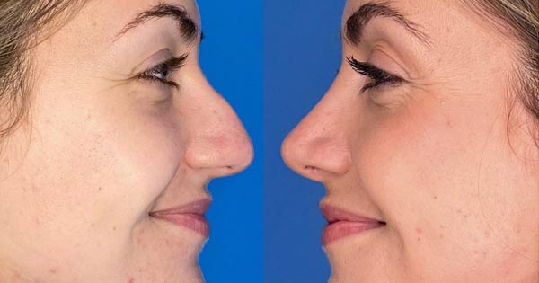 عمل بینی در تهران