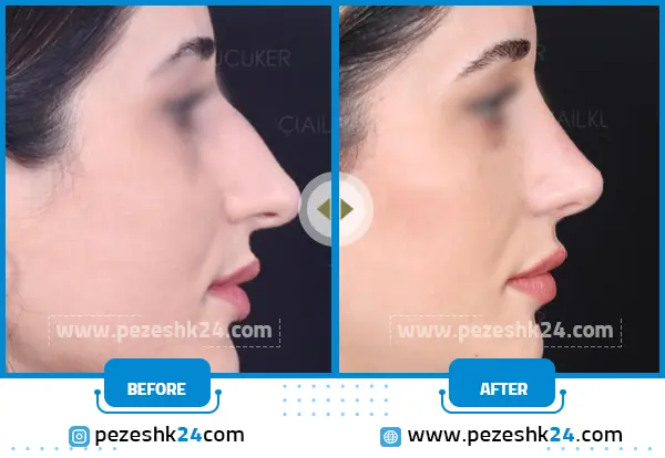 قبل و بعد عمل بینی غضروفی شیراز