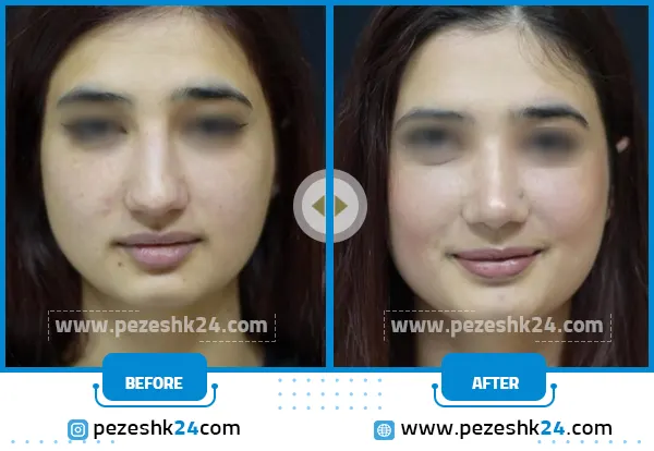 قبل و بعد از عمل انجراف بینی شیراز
