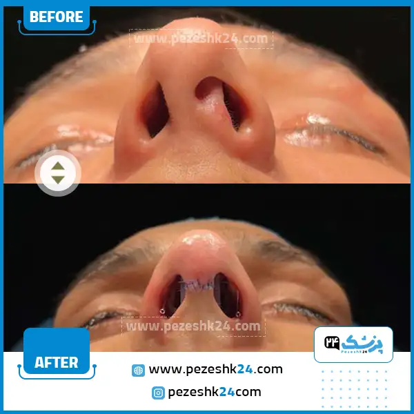 قبل و بعد عمل بینی ترمیمی در شیراز