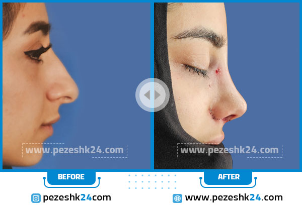 قبل و بعد عمل بینی دکتر براتی در اصفهان