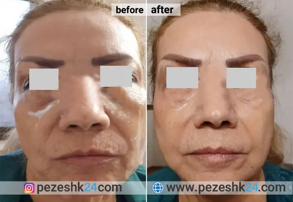 نمونه کار هایفوتراپی دکتر حیدری در مشهد 4