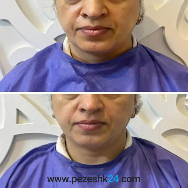 نمونه هایفوتراپی کلینیک دلوین در مشهد 4