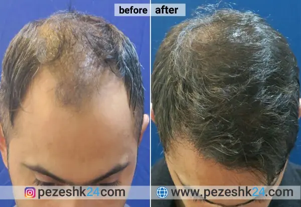 نمونه کاشت مو در کلینیک صدف اصفهان 3