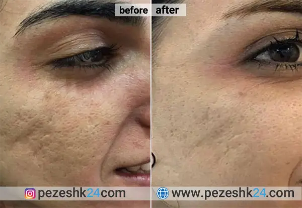 نمونه میکرونیدلینگ در کلینیک سایه مشهد 1