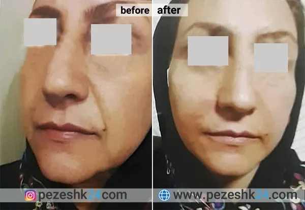 نمونه کار هایفوتراپی در کلینیک دکتر حیدریان 3