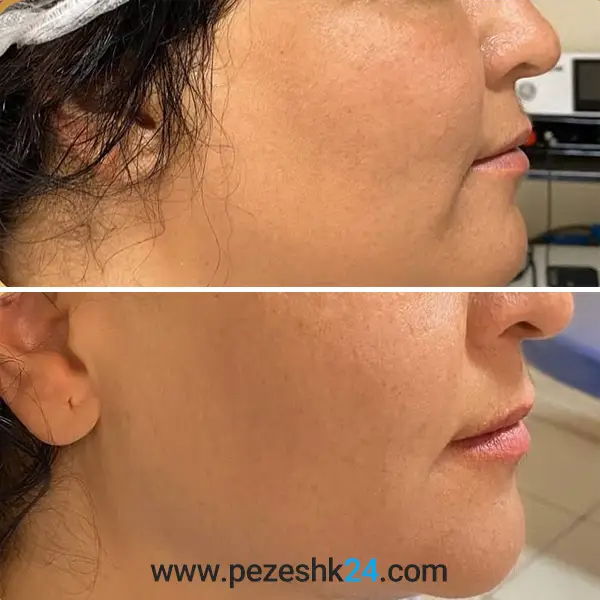 نمونه کار هایفوتراپی در کلینیک رومینا 2