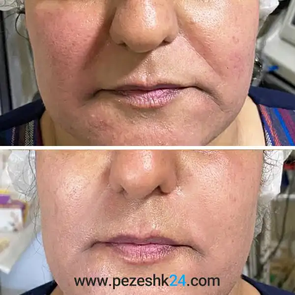 نمونه کار هایفوتراپی در کلینیک رومینا 3