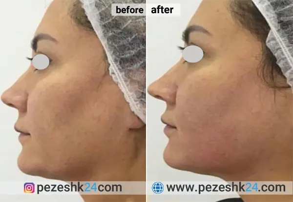 نمونه کار هایفوتراپی در کلینیک سان 1