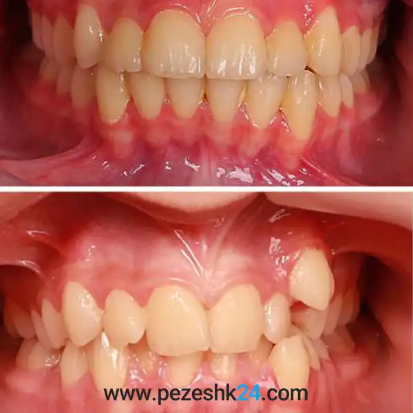 قبل و بعد ارتودنسی دندان دکتر فاطمه معصومی