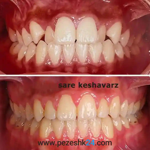 عکس از قبل و بعد ارتودنسی دندان دکتر کشاورز در رشت