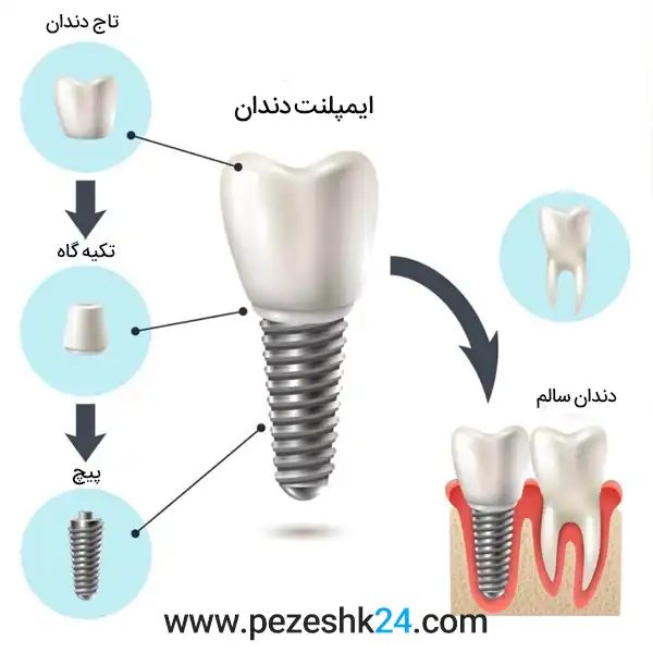 ساختار کلی ایمپلنت دندان تهران