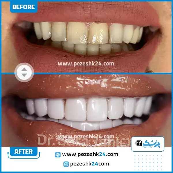 عکس قبل و بعد پولیش دندان دکتر رحیمی