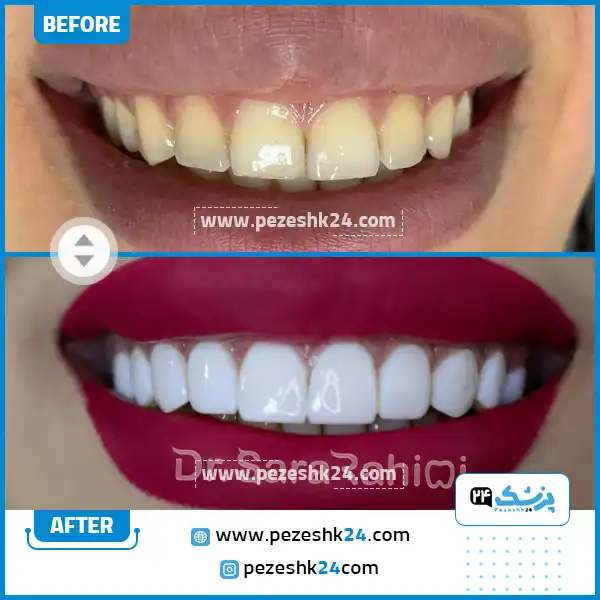 قبل و بعد ونیر کامپوزیت دکتر رحیمی