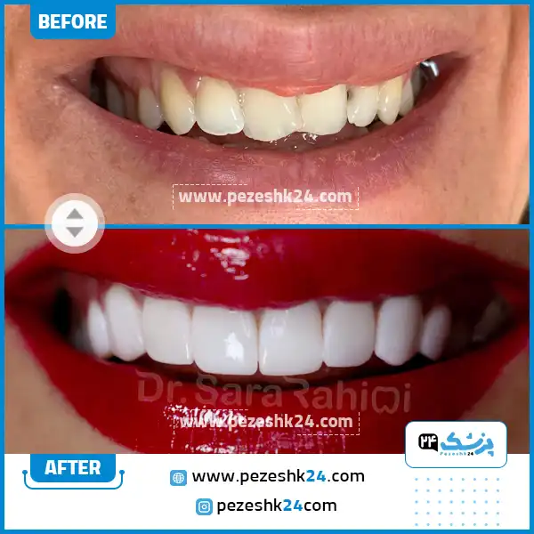 قبل و بعد ونیر کامپوزیت دکتر رحیمی رشت
