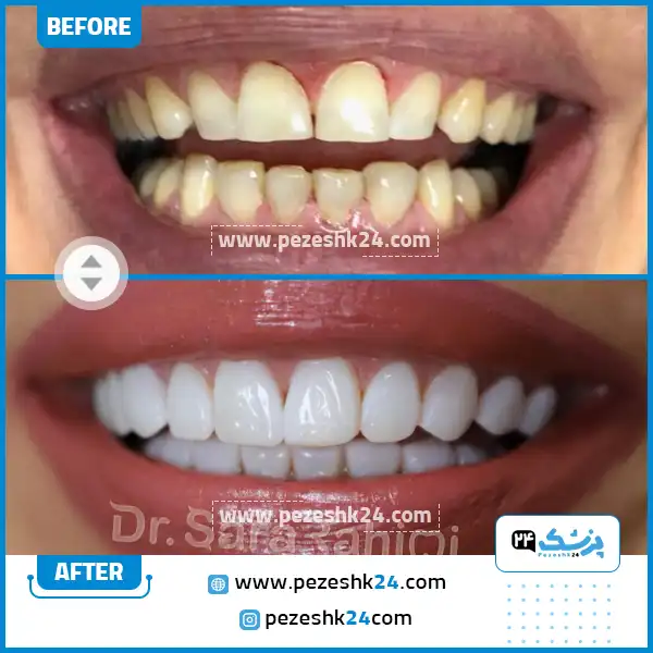 قبل و بعد کامپوزیت دکتر رحیمی
