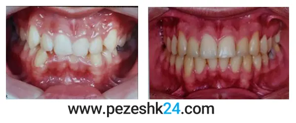 نمونه کار قبل و بعد ارتودنسی دندان دکتر سیدجوادین 