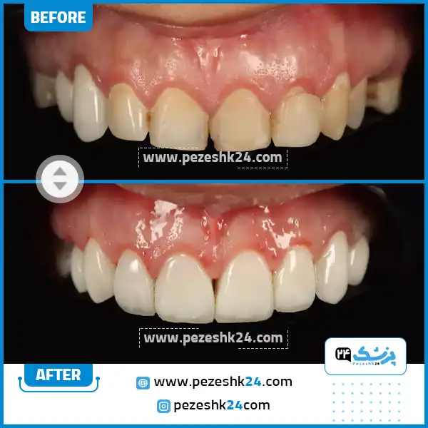 قبل و بعد کامپوزیت دندان کلینیک آپادانا