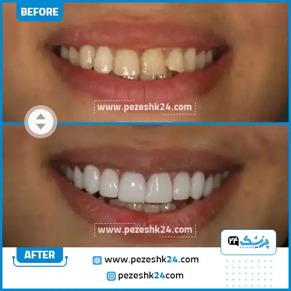 قبل و بعد از ونیر کامپوزیت مرکز آپادانا