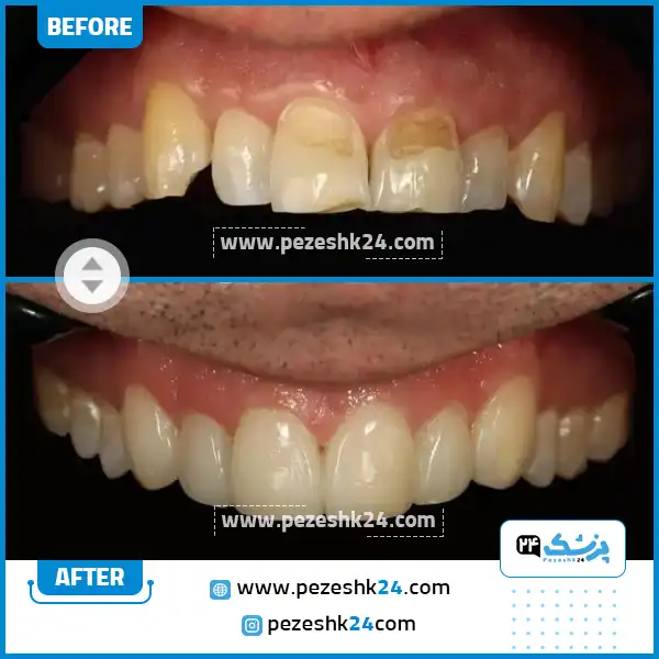 قبل و بعد از کامپوزیت مرکز آپادانا