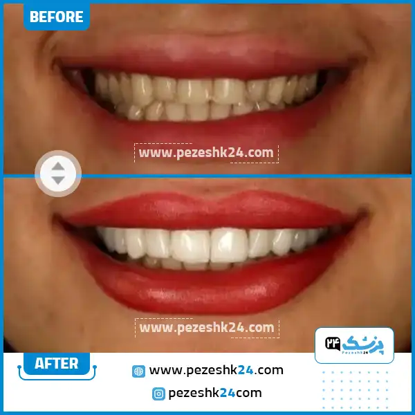 قبل و بعد ونیر کامپوزیت مرکز آپادانا