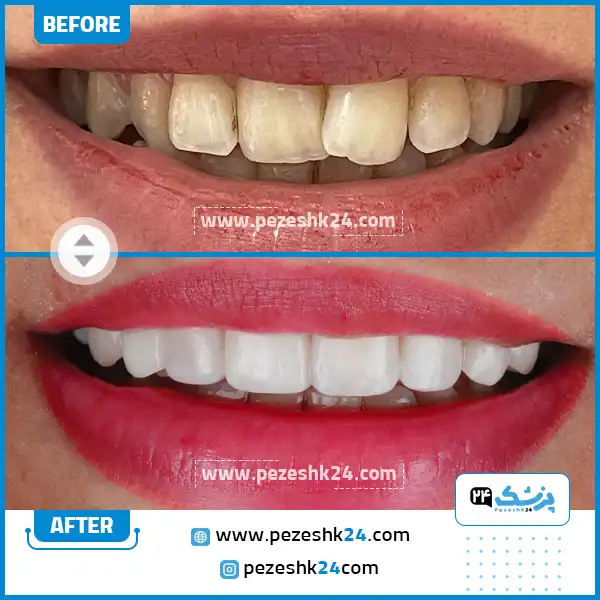 قبل و بعد کامپوزیت ونیر دکتر صادقی رشت