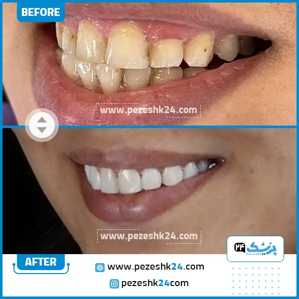 قبل و بعد از کامپوزیت ونیر دکتر صادقی