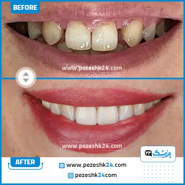 قبل و بعد از کامپوزیت دکتر یاسمن صادقی