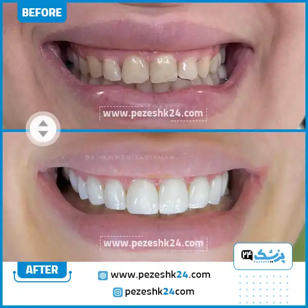 قبل و بعد کامپوزیت ونیر دکتر ایزدی خواه