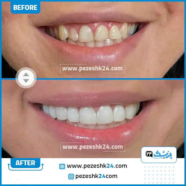 قبل و بعد کامپوزیت ونیر دکتر ایزدی خواه رشت