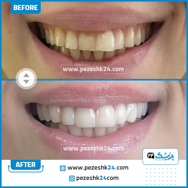 قبل و بعد ونیر کامپوزیت دکتر وجیهه ایزدی خواه