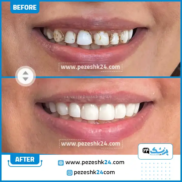 قبل و بعد ونیر کامپوزیت دندان دکتر ایزدی خواه