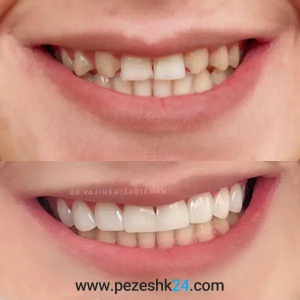 قبل و بعد لمینت دندان دکتر وجیهه ایزدی خواه