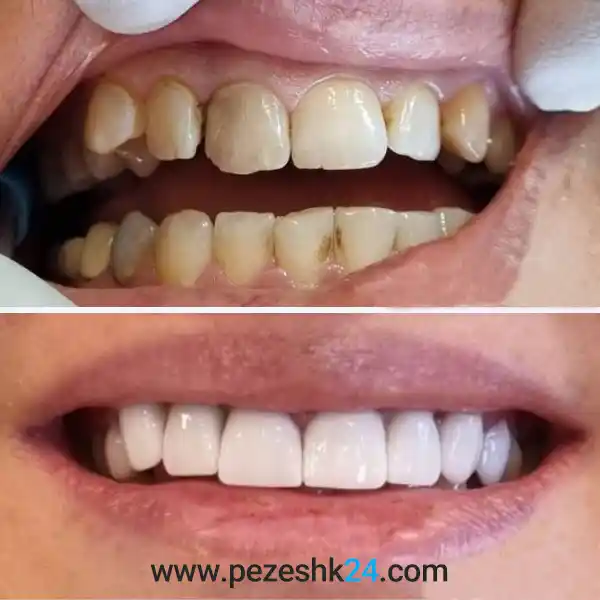 اصلاح ناهنجاری دندان با لمینت سرامیکی