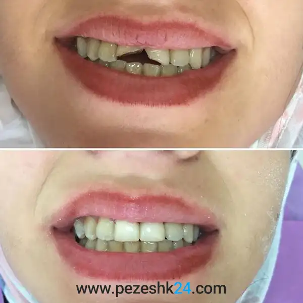 قبل و بعد لمینت دندان توسط دکتر صادقی 
