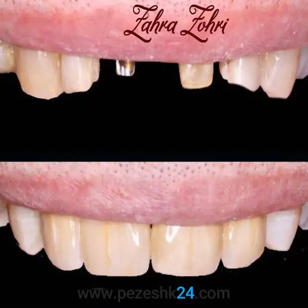 نمونه قبل و بعد کاشت دندان دکتر ظهری در رشت