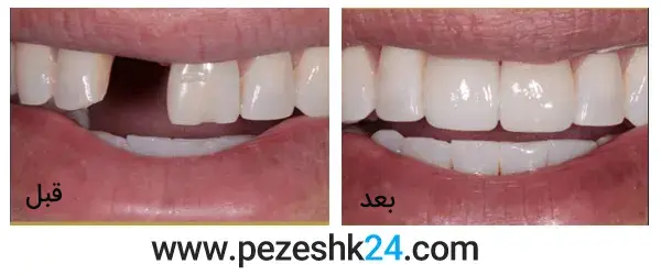 قبل و بعد ایمپلنت دندان در رشت