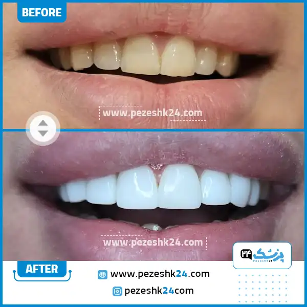 قبل و بعد کامپوزیت دندان دکتر موسوی آزاد