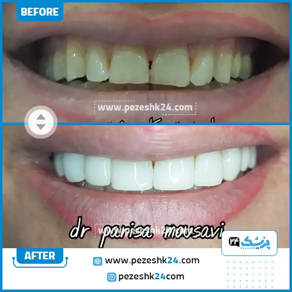 قبل و بعد کامپوزیت دکتر موسوی آزاد