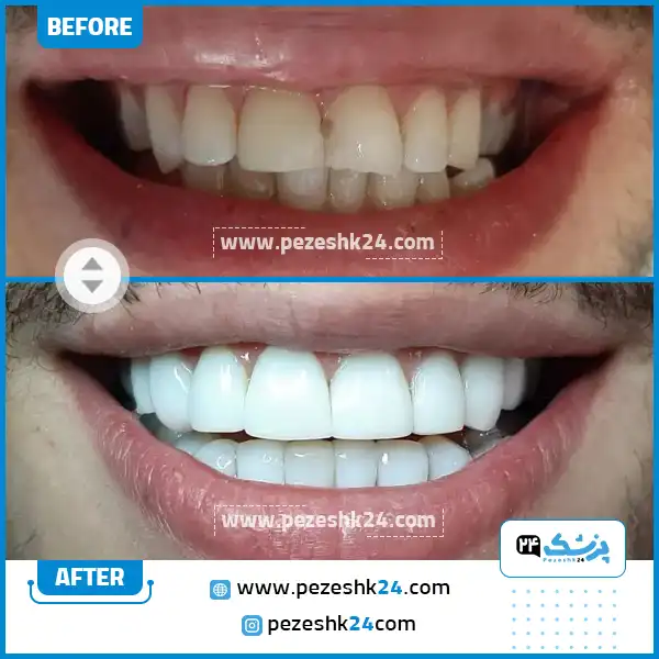 قبل و بعد از کامپوزیت دکتر موسوی آزاد