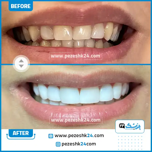 قبل و بعد کامپوزیت ونیر دکتر موسوی آزاد