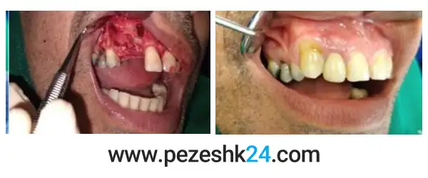 نمونه کار ایمپلنت دندان فک بالا دکتر پورسیدیان 