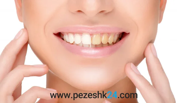 سفید کردن دندان با کامپوزیت