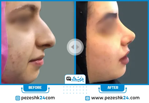 قبل و بعد جراحی زیبایی بینی دکتر آلانی قم